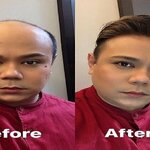 Hair transplant in singapore is swapping clothes online from 